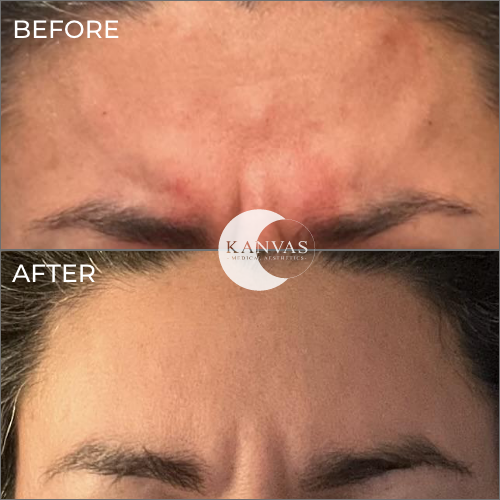 Botox Treatment Before After