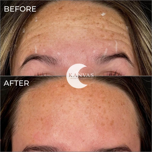 Botox treatment before after