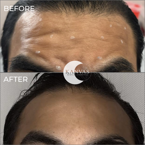 Botox Treatment Before After