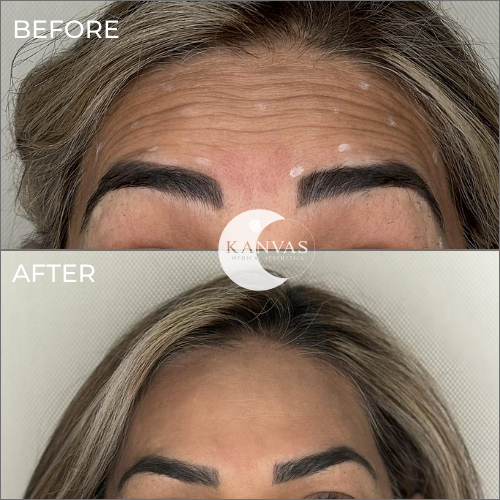 Botox Treatment Before After