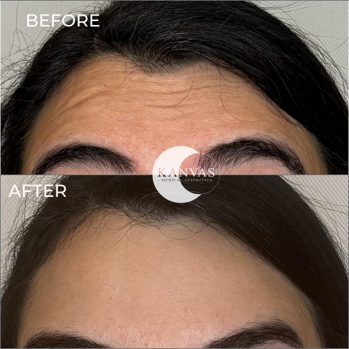 Botox Treatment Before After