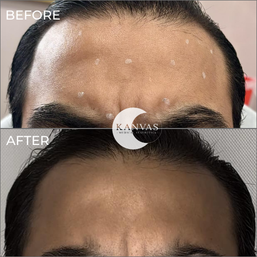 Botox Treatment Before After