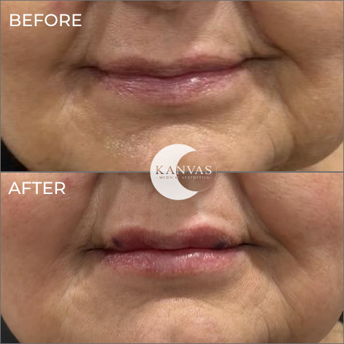 Lip Filler Treatment Before after