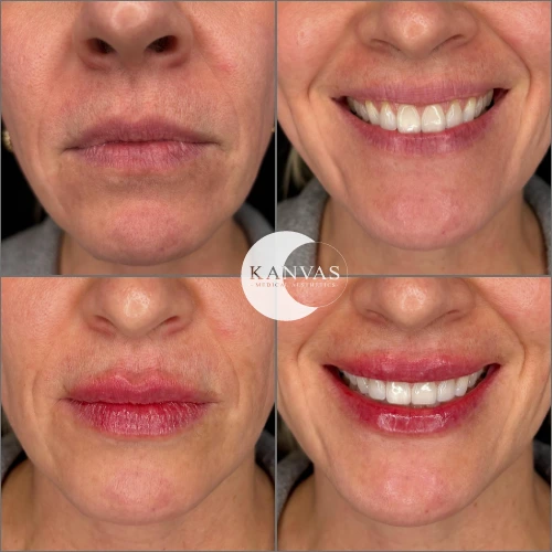 Lip Filler Treatment Before after