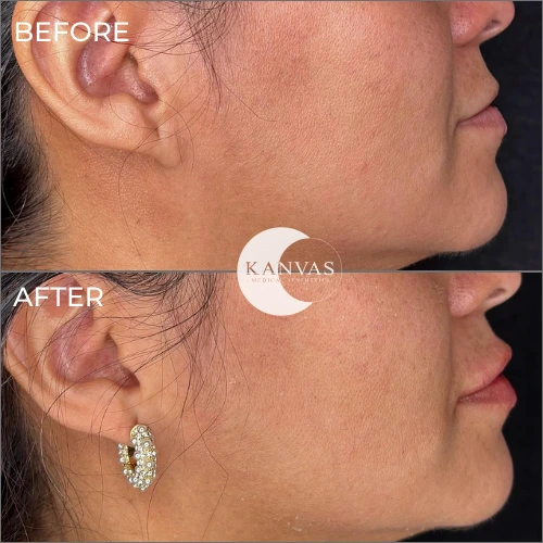 Lip Filler Treatment Before after