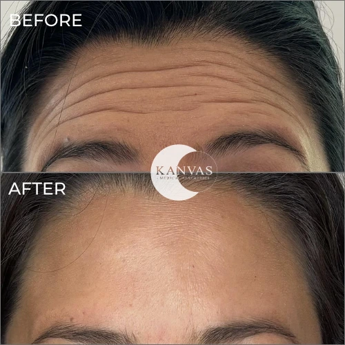 wrinkle relax before after