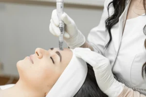 Microneedling
